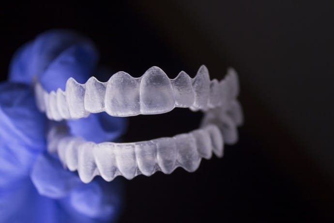 Invisible Braces Ottawa
