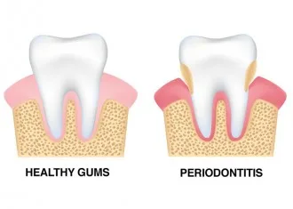 Gum Treatment