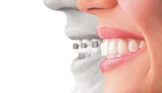 Metal Braces