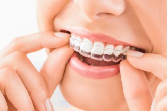 Invisalign Ottawa