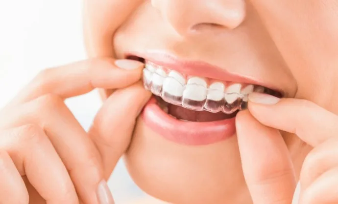 Invisalign Ottawa